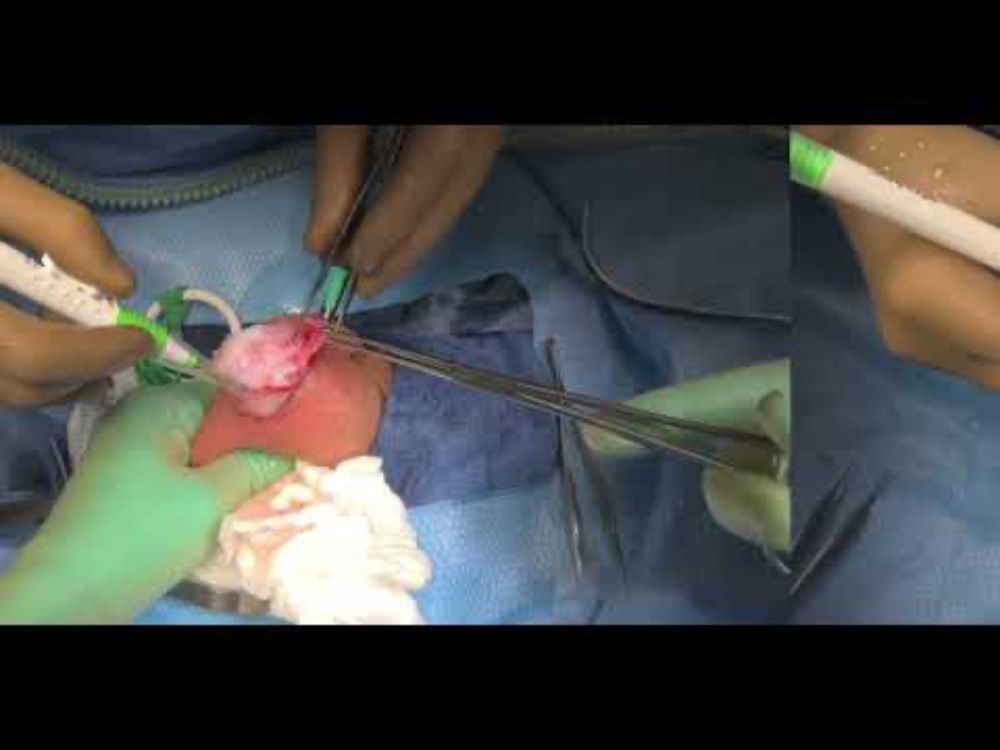 Hydrocelectomy filmed with Apple Vision Pro