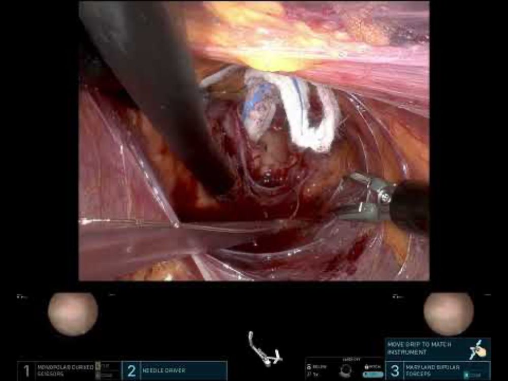SP robotic pyeloplasty, right side, Y-V flap for narrowed UPJ, 33 min uncut video.