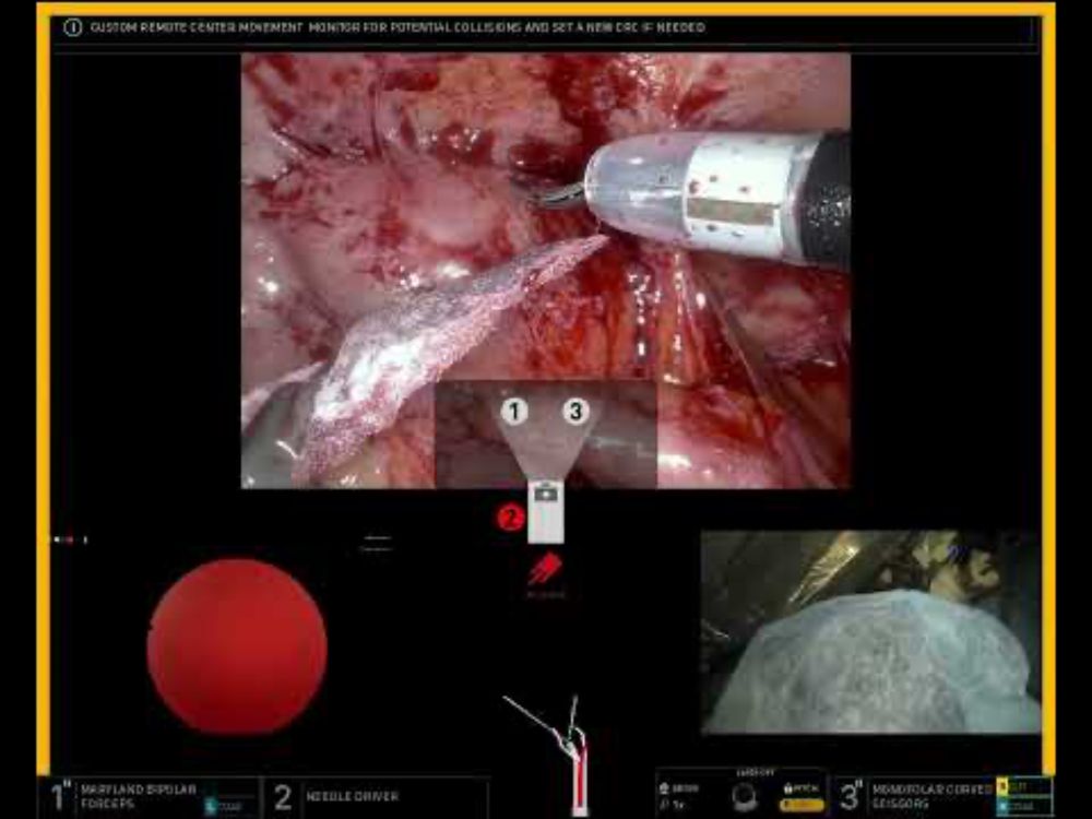 Right ureteroenteric stricture repair using SP robot, after APR.  Enterotomy and closure.