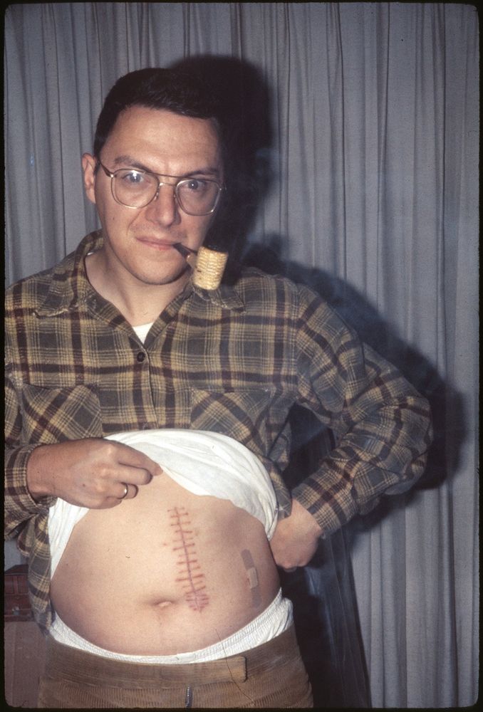 A man with glasses and a plaid shirt holding up his shirt to reveal a significant surgical scar on his abdomen. He is smoking a pipe and standing in front of drawn curtains.