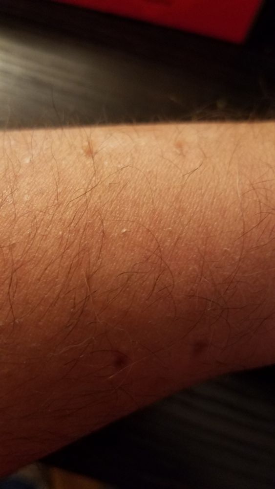 Photo of a section of my forearm, showing four deep fang indentations where my cat bit me.