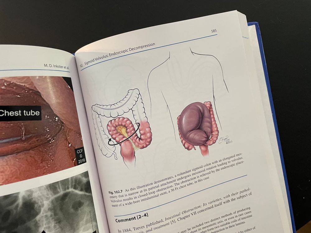 A photo from a page of the book Cleveland Clinic Colorectal Case Studies, featuring my illustration of a sigmoid volvulus