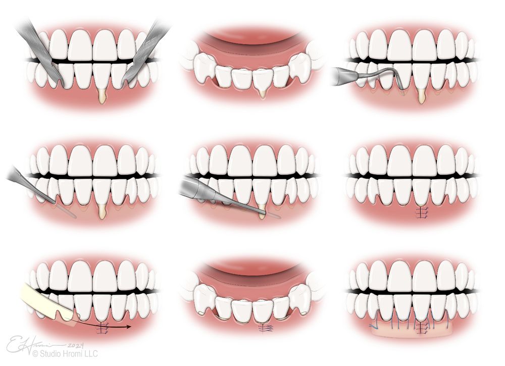 A #medicalIllustration showing a sequence of nine steps involved in periodontal surgery for deep gingival recession.