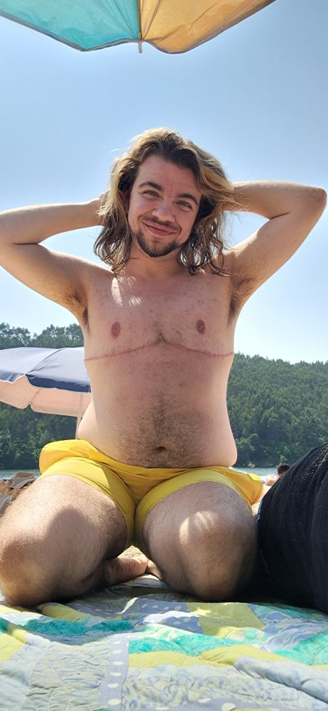 Photo of me on my knees, arms behind my head under the sun, proudly showing my top scars with a smile.