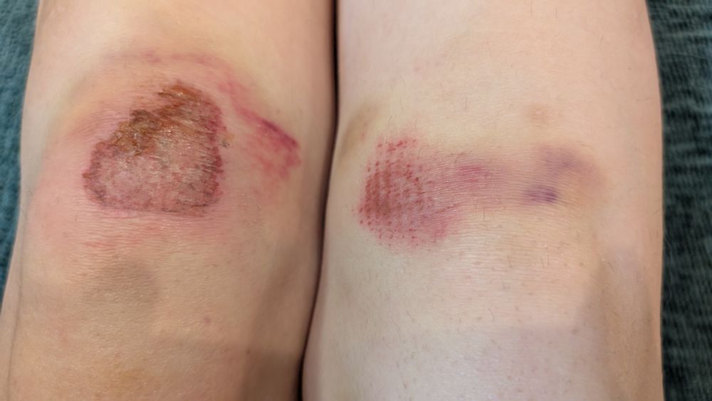 Scabs over scraped knees.