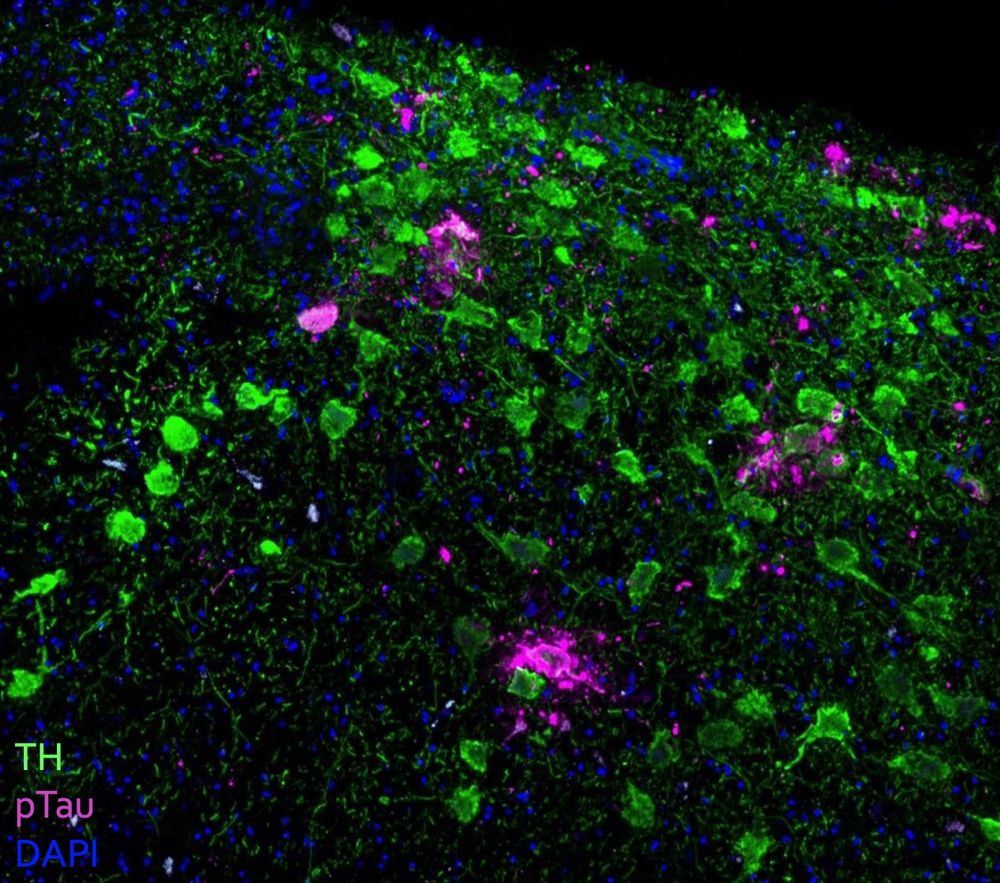 Fluorescence microscopy of a tissue section from locus coeruleus of the human brain, labeling for tyrosine hydroxylase in green and phosphorylated Tau in magenta