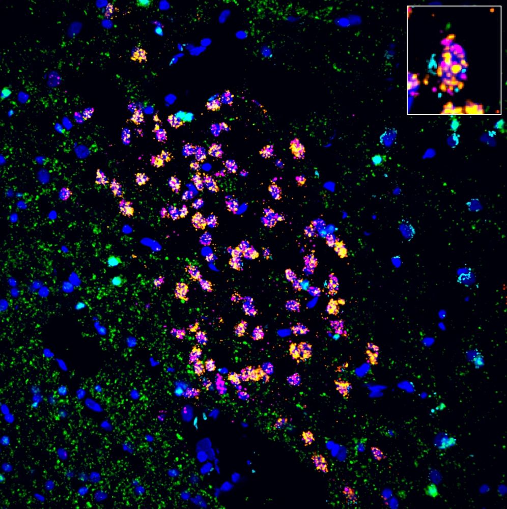 Microscopy image of single molecule fluorescence in situ hybridization to label population of D1-receptor interface islands in a section of human brain tissue at the level of the nucleus accumbens