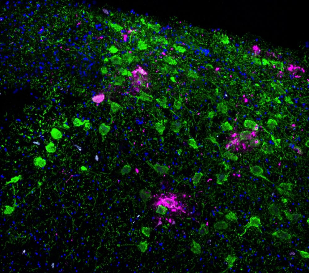 Staining in green (TH) to label noradrenergic neurons and magenta (pTau) in a tissue section through the locus coeruleus in the human brain