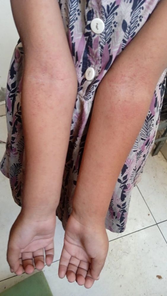 Pic of Mira’s arms covered in a red bumpy rash 