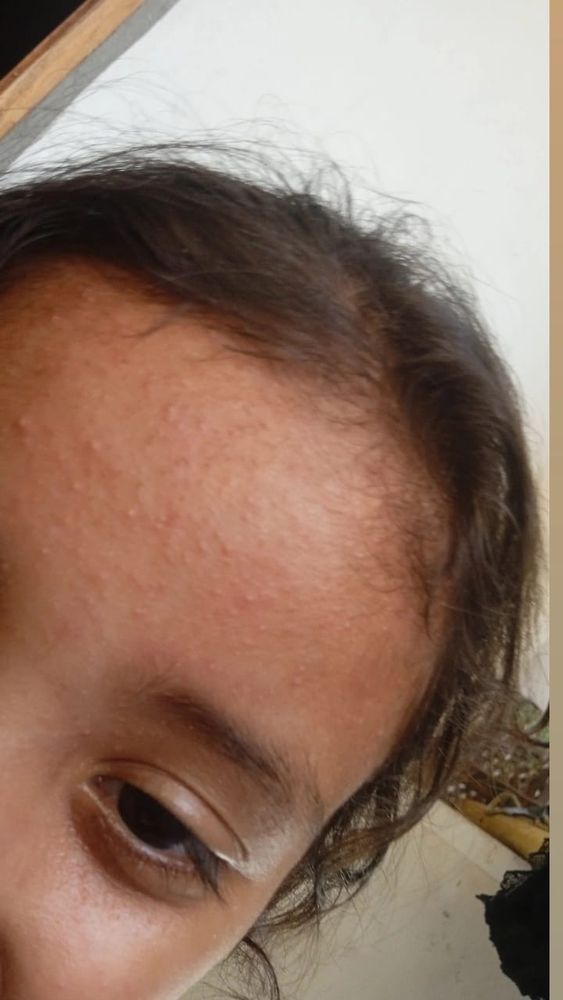 Pic of Mira’s forehead covered in a red bumpy rash 