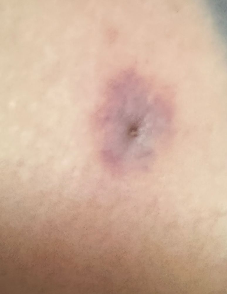 tick bite with the head stuck in