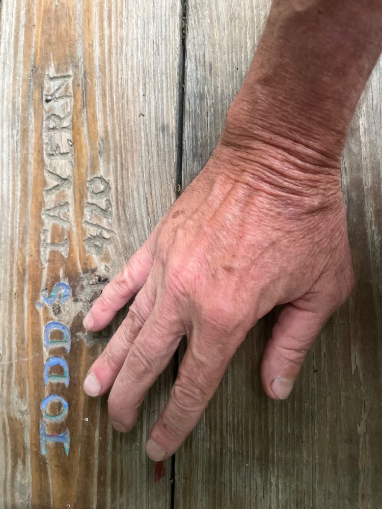 A man's right hand, showing a deformed middle finger, the result of having the end sewn back on crookedly after a dog bite.