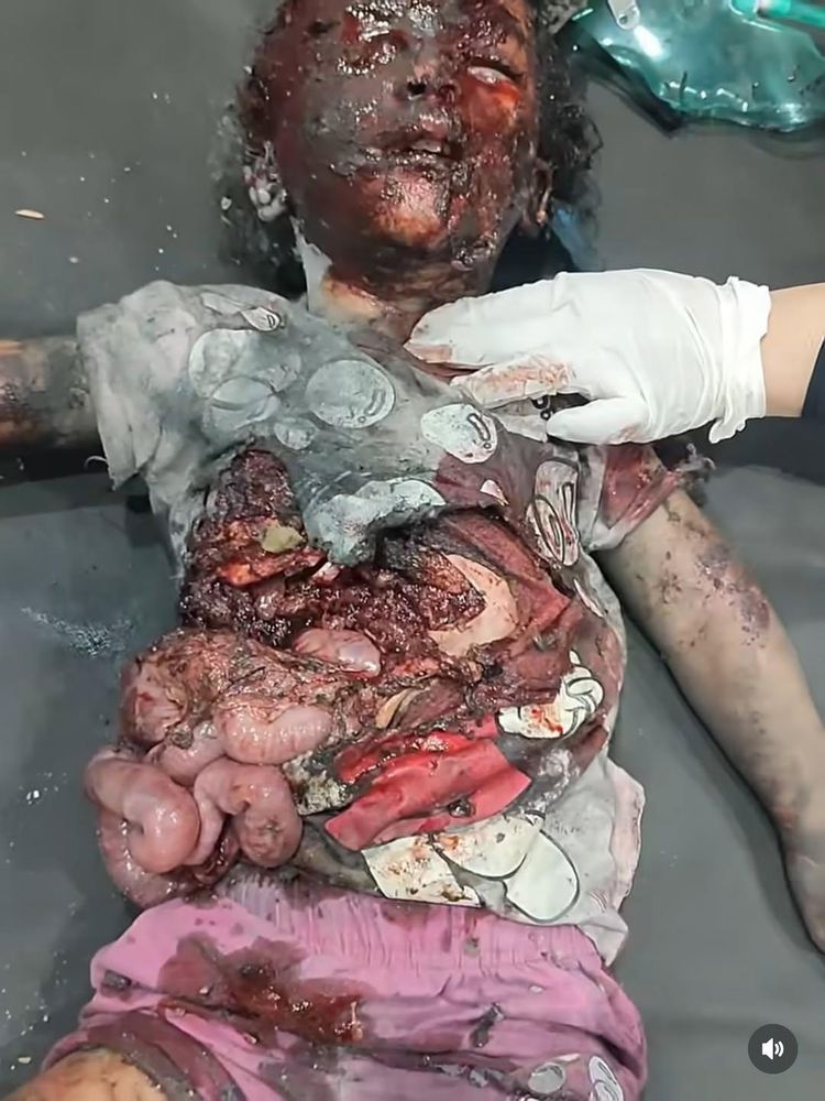 A Palestinian girl from Gaza with her face burned beyond recognition and her intestines spilling out.