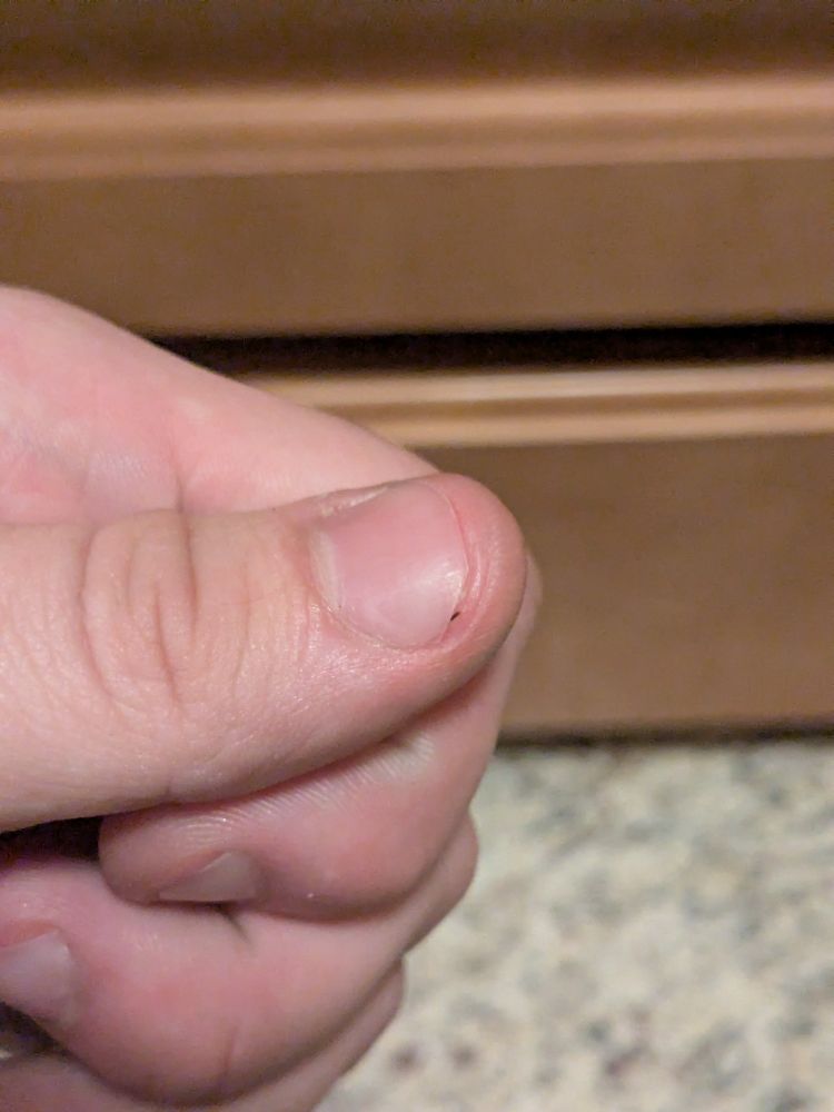 my hand with a cactus spine lodged under my thumbnail 