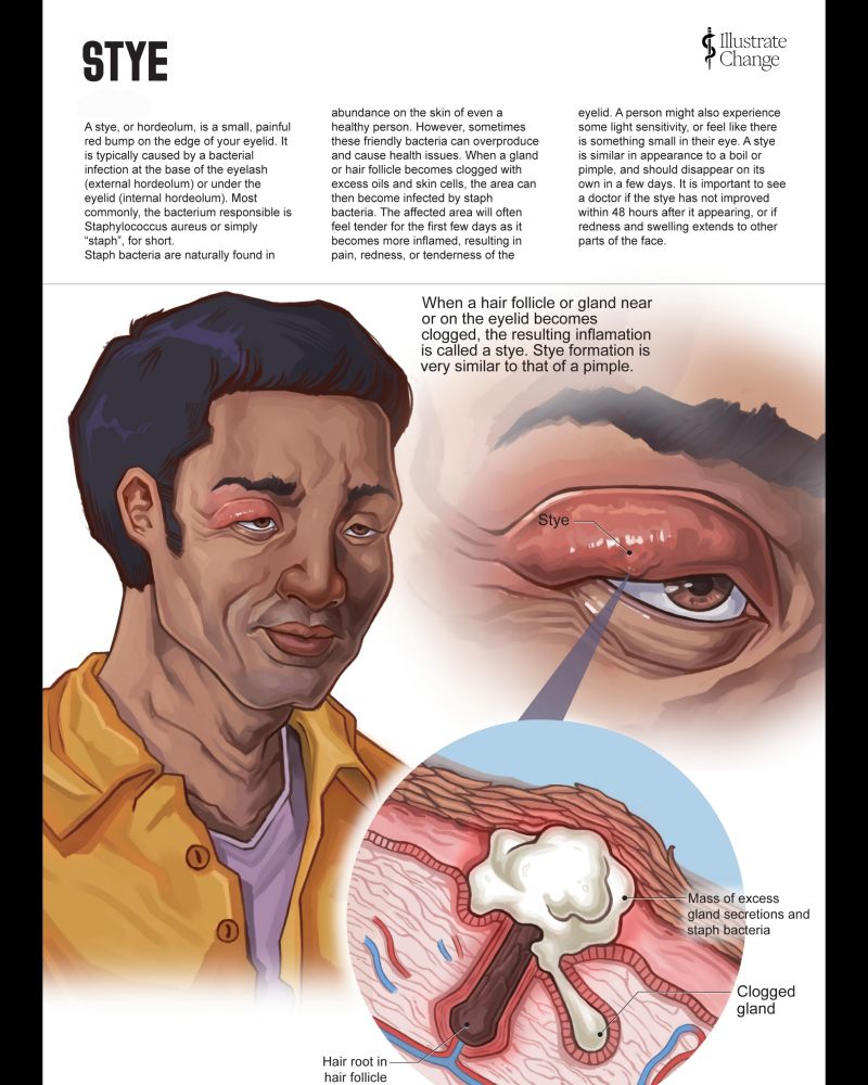 An asian man with a yellow shirt, tan skin and short black hair occupies the left hand side of the illustration. On the left, we see a zoom in on his eye, where we can appreciate the swelling of the eyelid and the formation of a stye on his right eye. 

Bellow the eye callout, we can see a cross-sectional diagram of the skin, which reveals that a skin follicle has been clogged by excess gland secretions and staph bacteria.