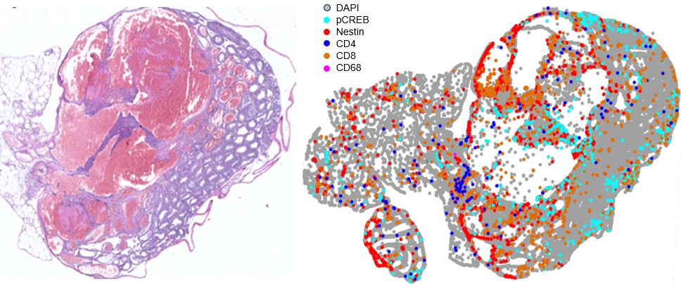 HE stained testis exhibiting a sex cord stromal-like tumor on the left & in the right, a spatial map showing tumor & immune cells (see color key)