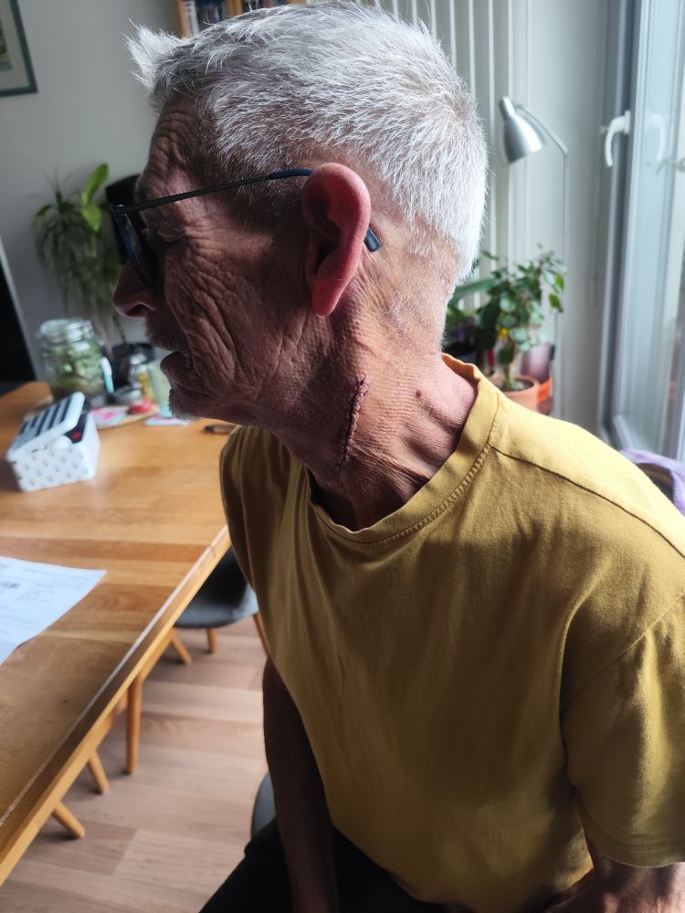 Un homme aux cheveux blancs courts de profil, en t-shirt shirt jaune exposé la cicatrice de 10 cm sur sa carotide gauche.