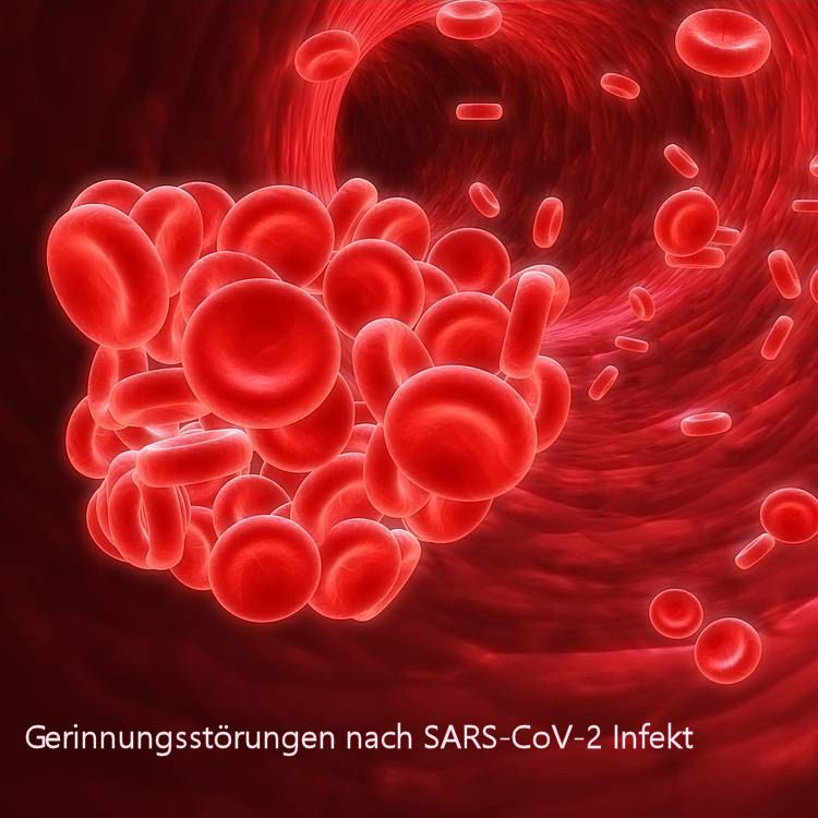 Die Abbildung zeigt bildlich die Gefahr von Gerinnungsstörungen nach SARS-CoV-2 Infekt. Die Gefahr von ernsten Folgen wie Herzinfarkt, Schlaganfall oder Lungenembolie steigt erheblich an.