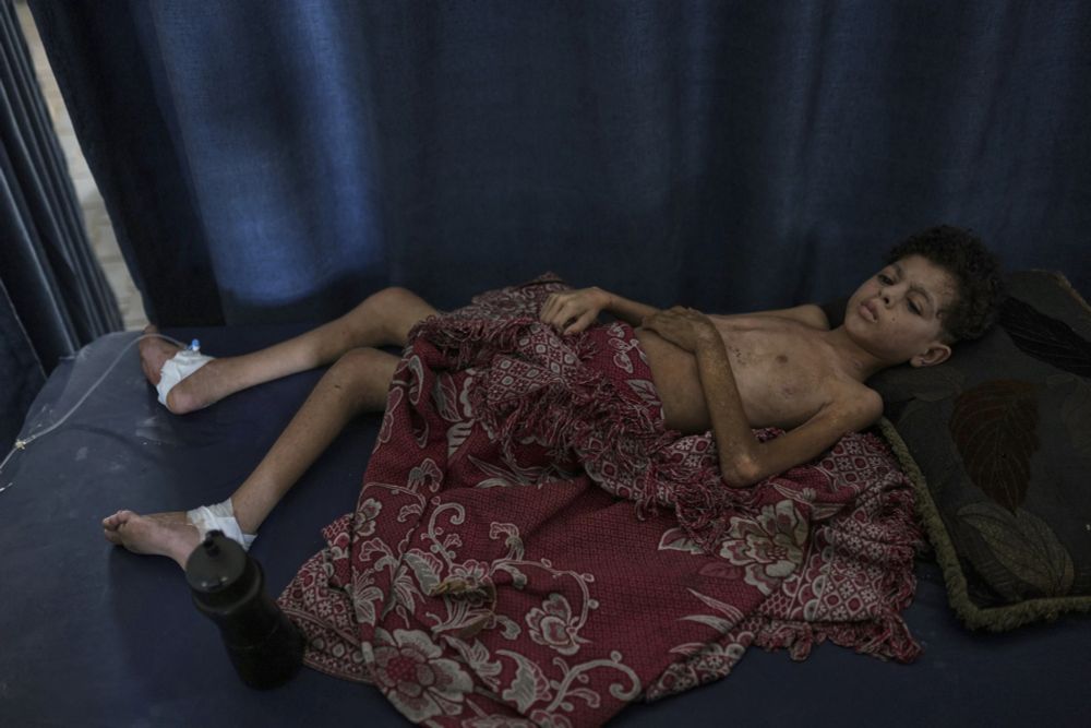 Saif Hijazi, 13, who suffers from severe malnutrition and was partially paralyzed by shelling lies on a bed to have his picture taken at the Shifa Hospital where he is being treated in Gaza City, Monday, July 28, 2025. In Gaza, malnutrition is often worsened by preexisting conditions and compounded by illnesses linked to inadequate health care and poor sanitation, largely the result of the ongoing war. (AP Photo/Jehad Alshrafi)