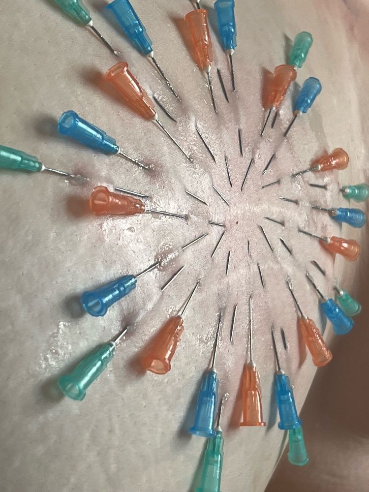 A closeup of a needle design through skin. 