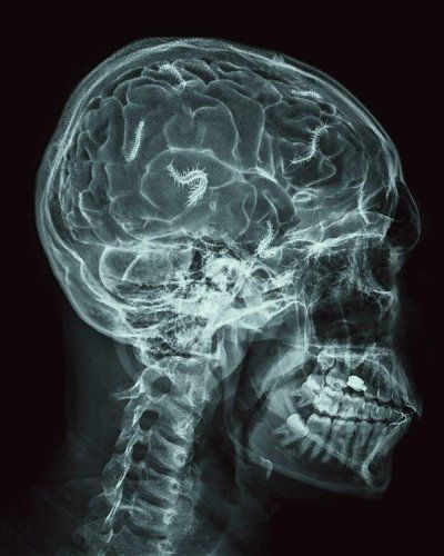 Head x-ray with brain worms.