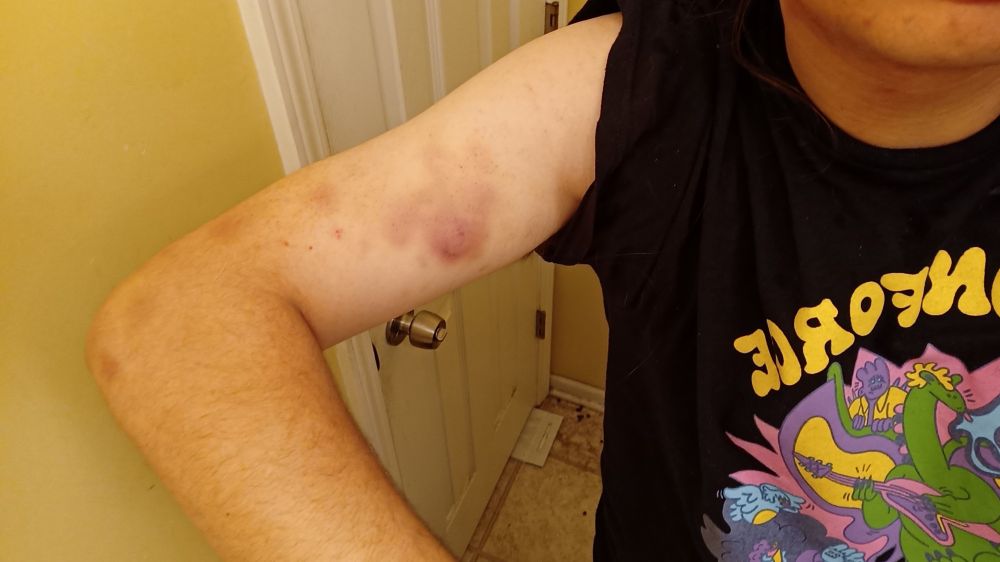 Lots more bruises