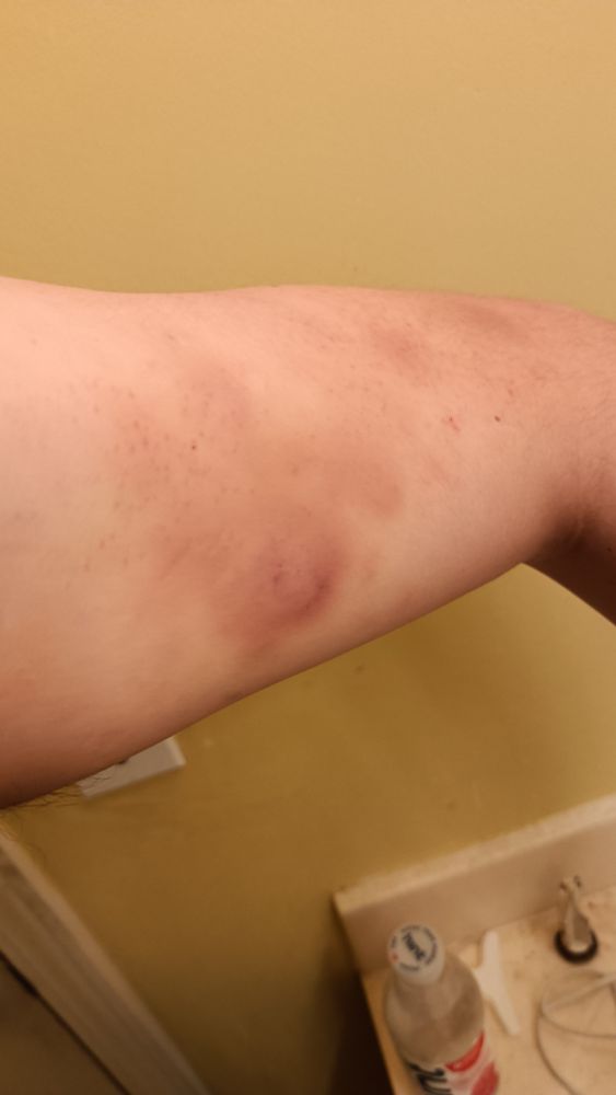 Bruises