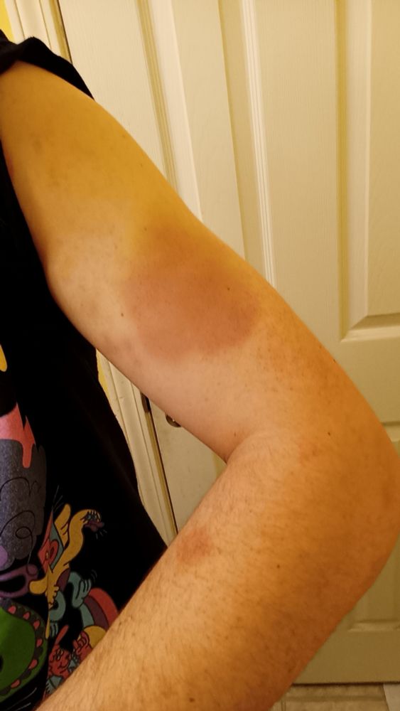 A big bruise and a small bruise