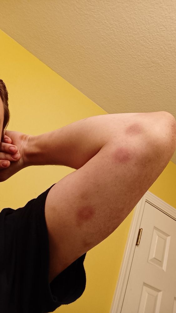 More bruises