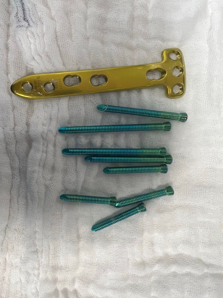 Eine Titanplatte und Schrauben, die verwendet werden, um eine Fehlstellung der Beinachse zu korrigieren, hier 3 Jahre nach der Umstellungsosteomie explantiert. 