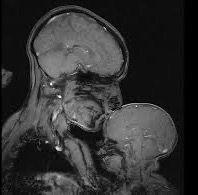 MRI image of a parent kissing a baby's forehead.