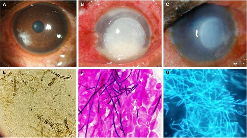 Top: Image shows photographs of three eyes with fungal keratitis with classical presentation.  
Bottom: representative images of fungal filaments stained with KOH, Grams stain and calcofluor white.