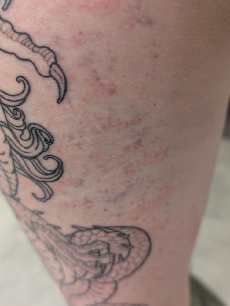 Close up photo of red and purple bruise on/around a new tattoo on Karin's thigh