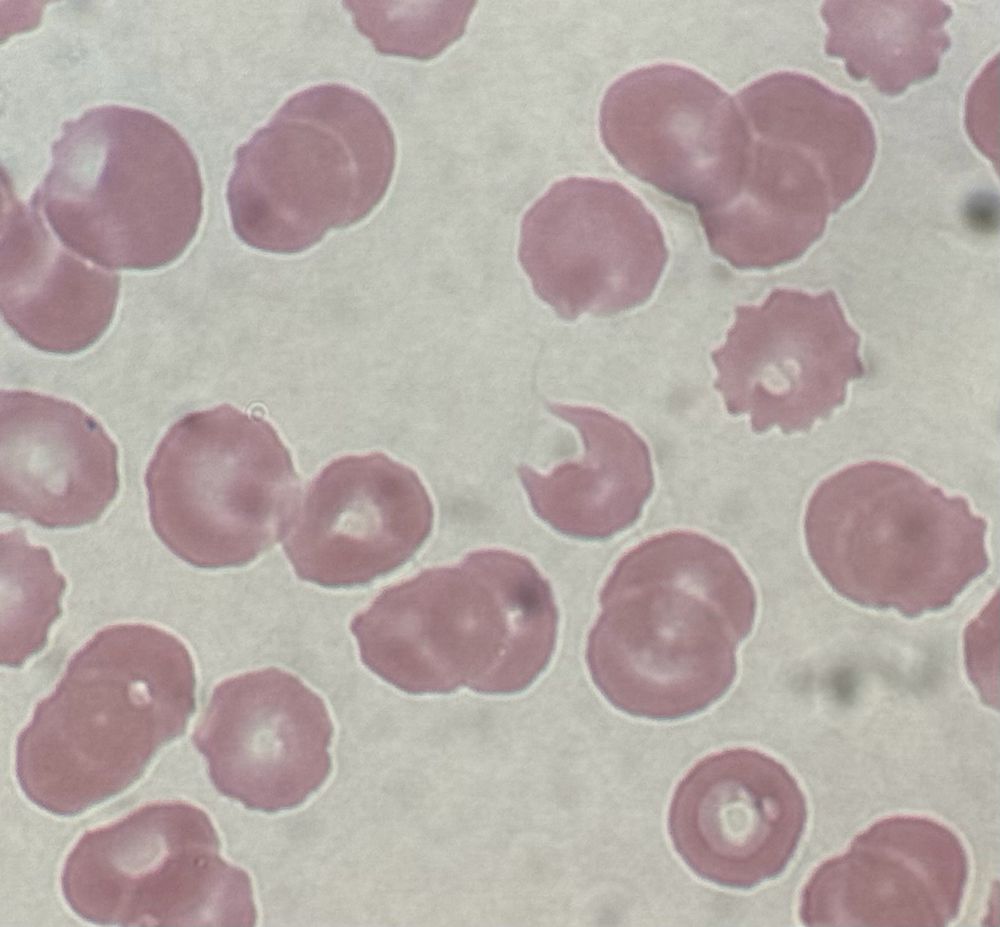 a peripheral blood smear with a bite cell