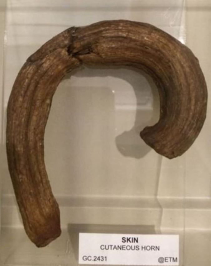 A curved "horn". Underneath it is a label which reads skin cutaneous horn 
