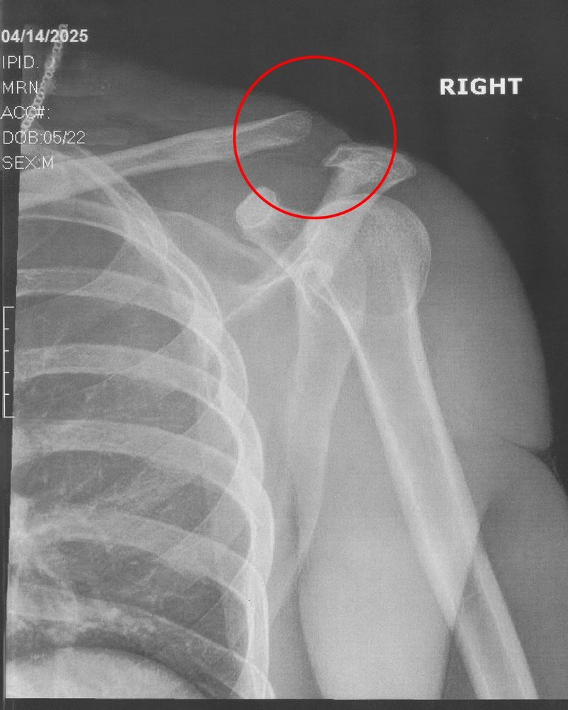 X-Ray of a Type III AC Joint Separation