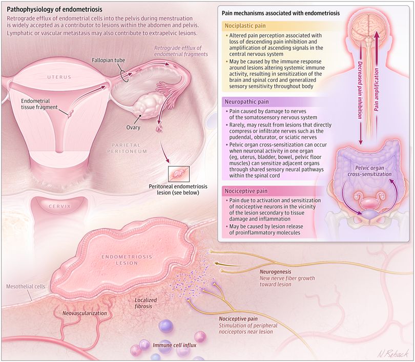 Figure 2.  Pathophysiology and Pain Mechanisms in Endometriosis-Associated Pelvic Pain
