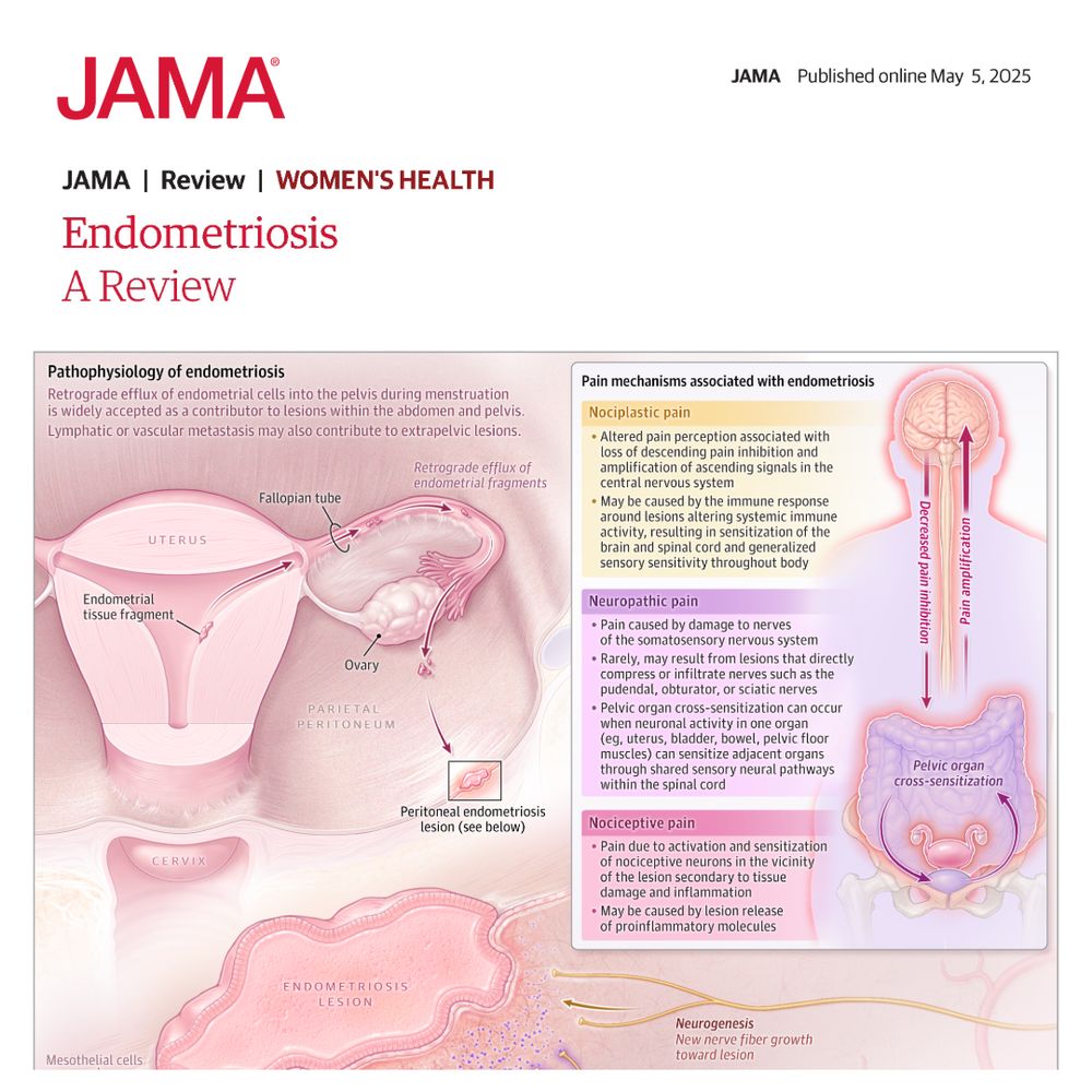 Figure 2.  Pathophysiology and Pain Mechanisms in Endometriosis-Associated Pelvic Pain
