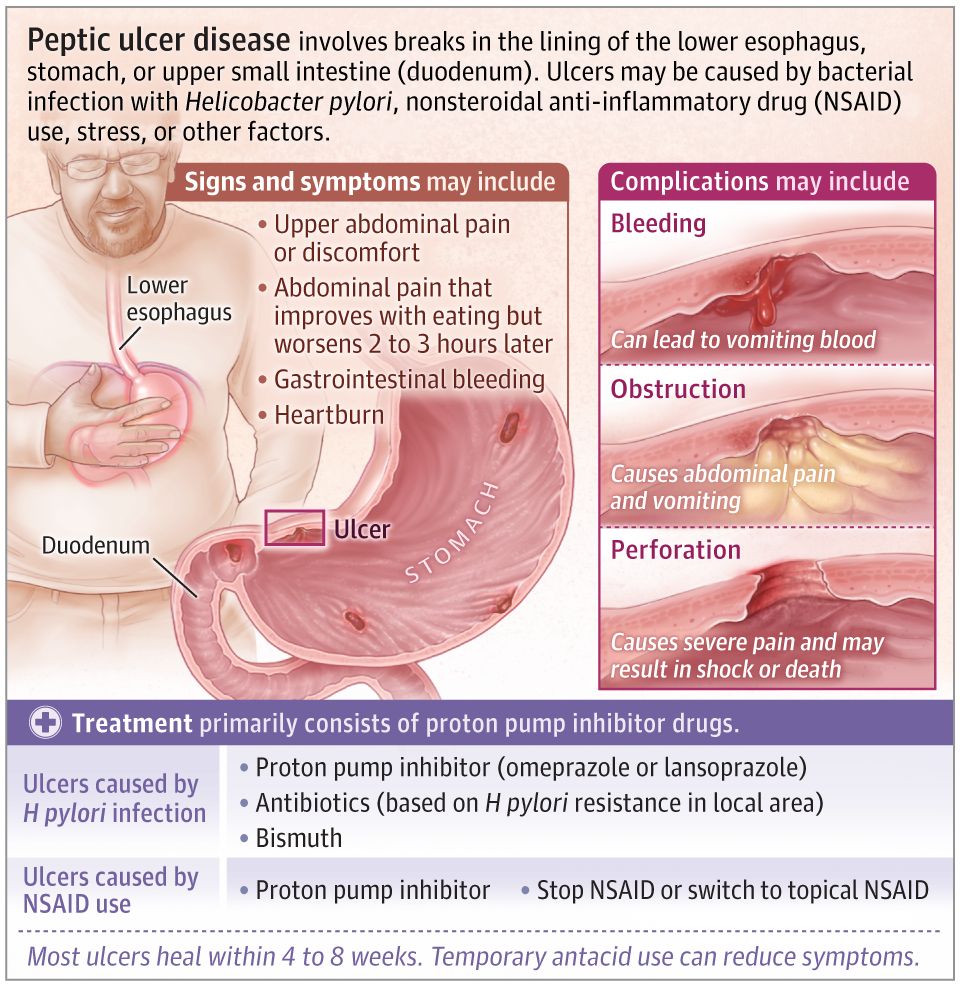 Peptic Ulcer Disease
JAMA Patient Page
