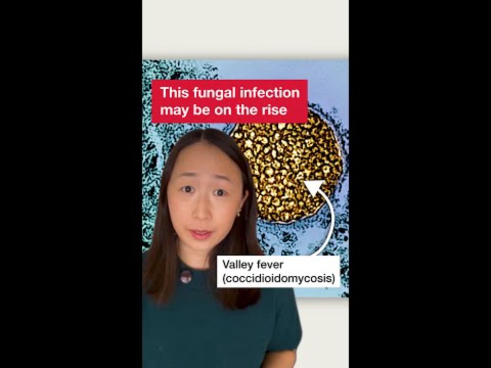 Valley fever, aka coccidioidomycosis, may be on the rise