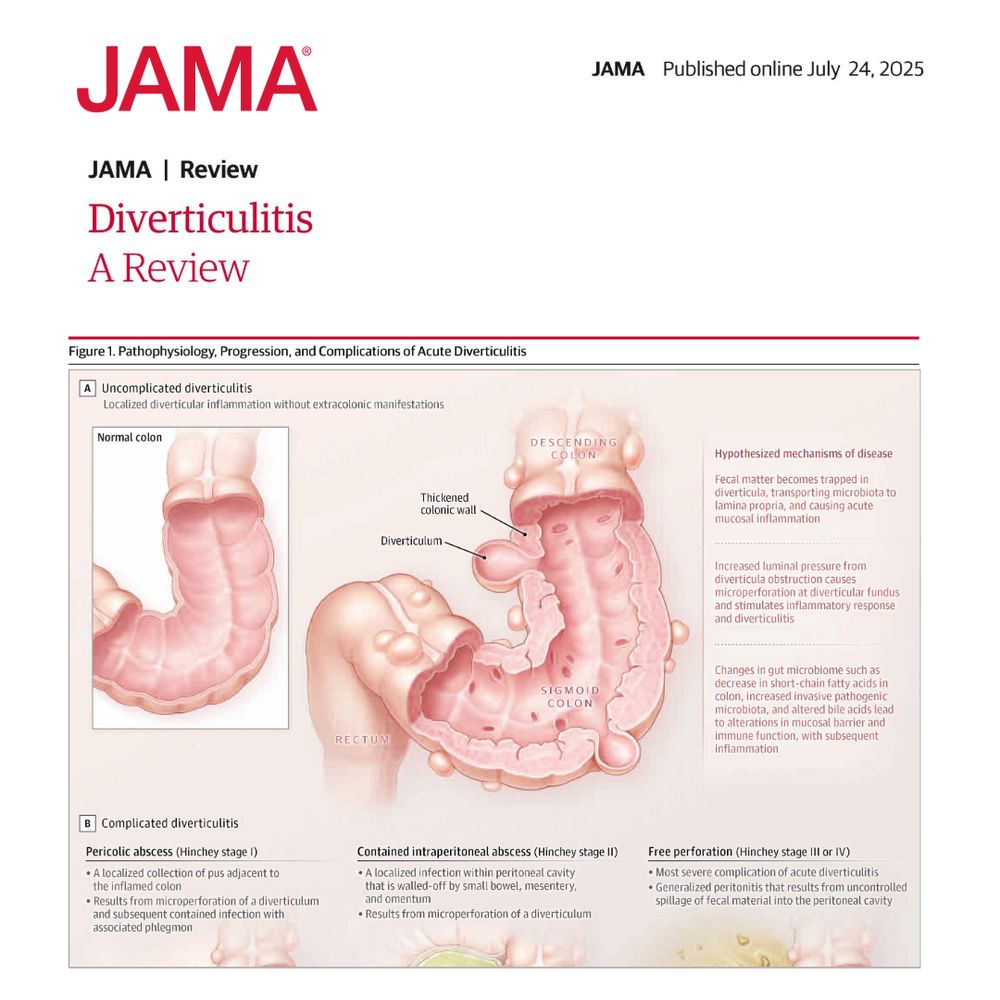Figure 1. Pathophysiology, Progression, and Complications of Acute Diverticulitis