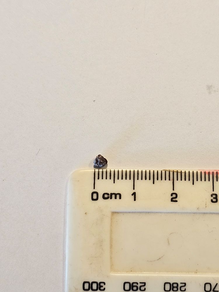 Renal stone fragment.