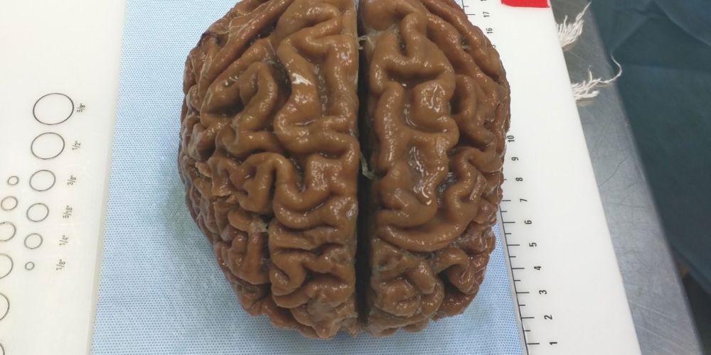 Nectome will preserve your brain, but you have to be euthanized first.