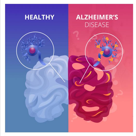 alzheimer's graphic