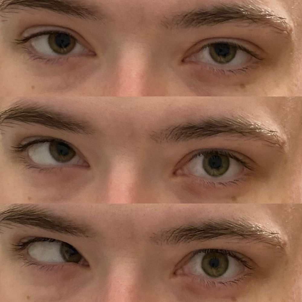 A three-image collage of Jett making their right eye (which does ~70% of their seeing on its own; the eyes never, ever work together, but can toggle extremely fast) go out of alignment into an up-and-in turn.