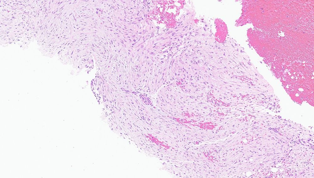 Desmoid tumor with haphazard spindle cell arrangement. 