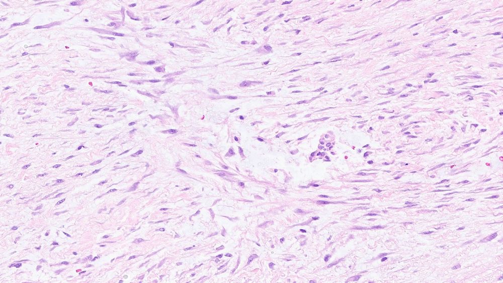 Focal vessel with perivascular edema. 