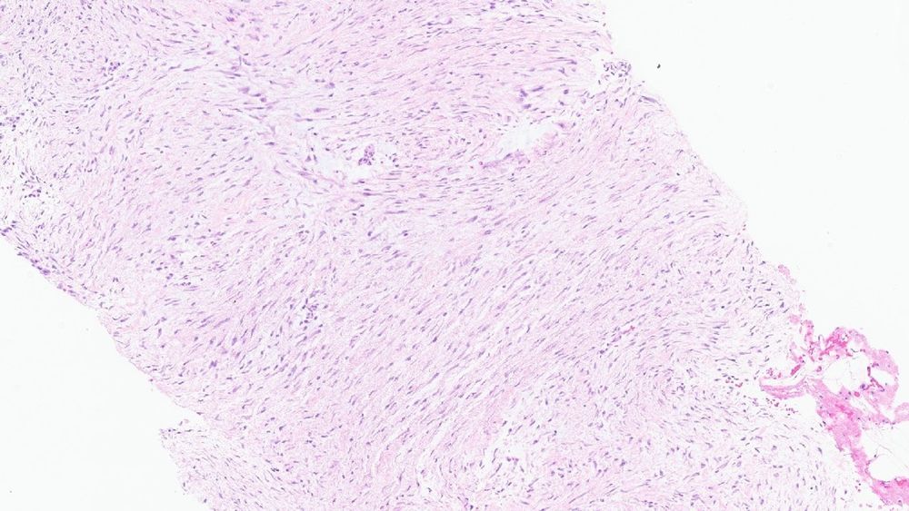 Focal areas of more fascicular like architecture in desmoid tumor. 