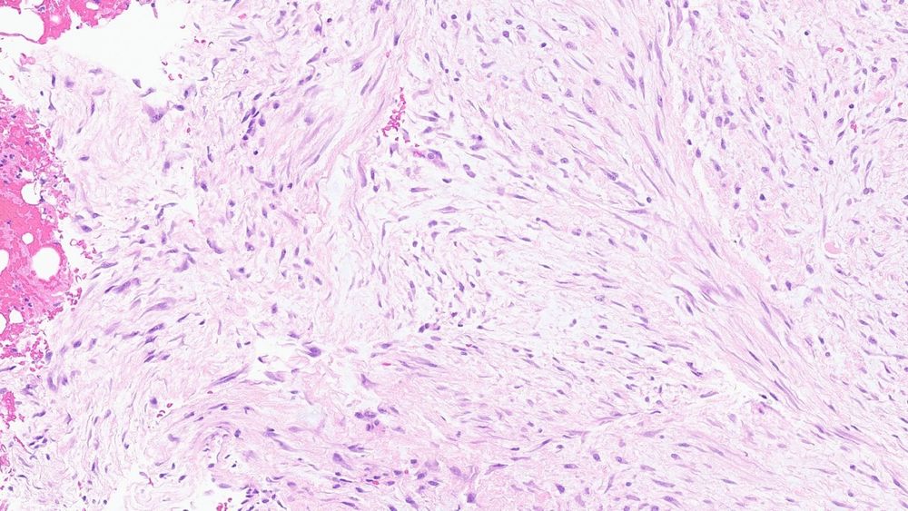 Desmoid tumor with haphazard spindle cell arrangement. 
