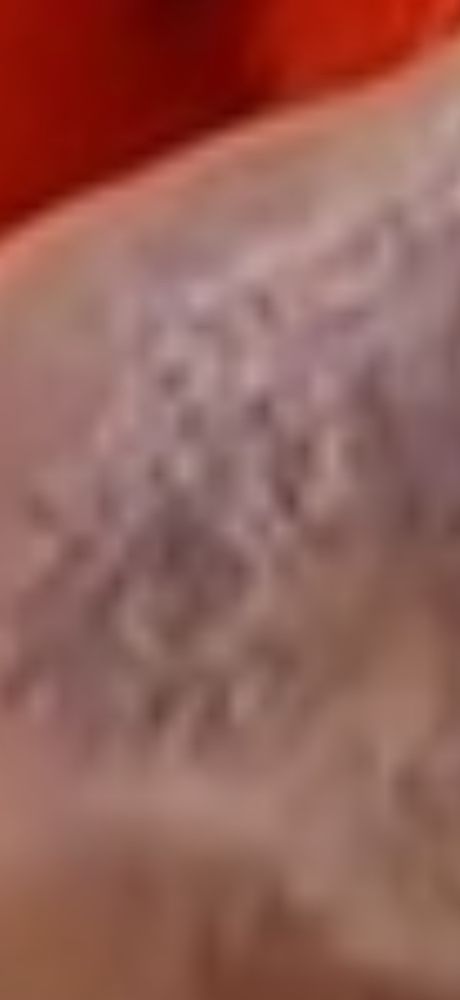 An even closer view of the bruise on his hand. 